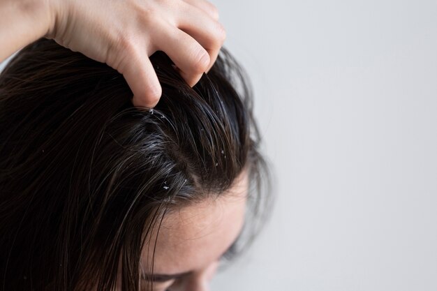 Understanding the science behind successful dandruff control with shampoos
